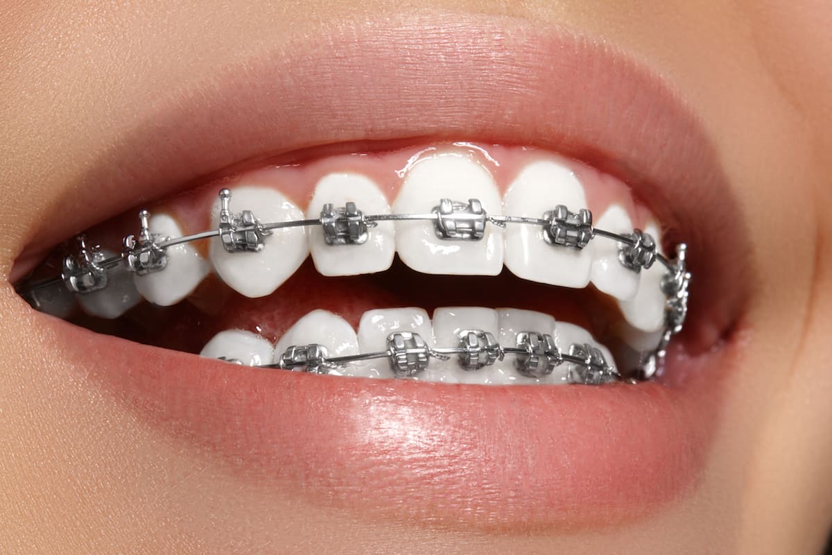 What is The Best Age for Braces?